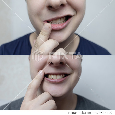 Before and after comparison of a young person with facial nerve palsy, Bells palsy. Concept of neurology, recovery, treatment success, and medical Before and after comparison of a young person with facial nerve palsy, Bells palsy. Concept of neurology, recovery, treatment success, and medical 129324400