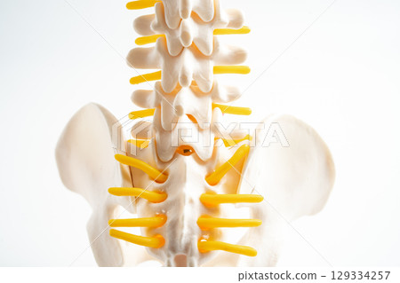 Lumbar spine displaced herniated disc fragment, spinal nerve and bone. Model for treatment medical in the orthopedic department. 129334257