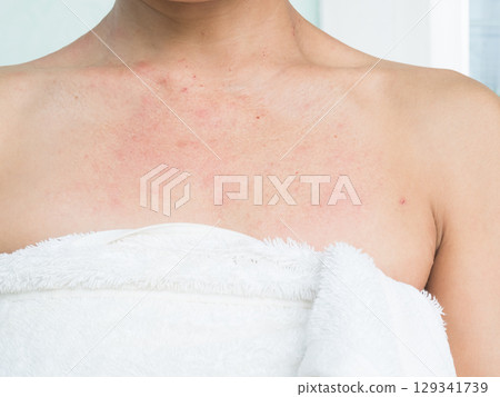 Woman with Urticaria Allergy Itchy Rash Eczema Itch Neck from Food,Air Poisoning,Cosmetic,Health,Body Care Disease Lilness Air,Dissease Medicine Calamine Lotion Treatment ,Infection Pain Sick Scratch. 129341739