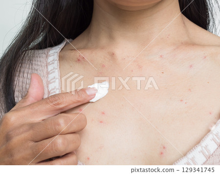 Woman with Urticaria Allergy Itchy Rash Eczema Itch Neck from Food,Air Poisoning,Cosmetic,Health,Medicine Body Care Disease Lilness Air,Dissease She Apply Calamine Lotion Treatment ,Infection Pain. 129341745