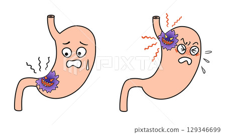 stomach cancer stomach cancer 129346699