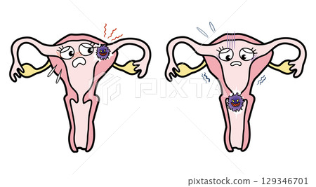 子宮癌 子宮癌 129346701