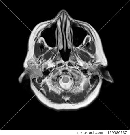 Axial T2-weighted MRI of the human brain at the level of the medulla oblongata, showing cerebellum, brainstem, and detailed cranial base anatomy. 129386787
