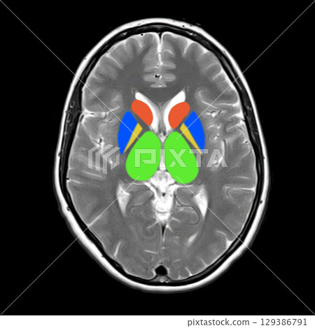 Normal brain anatomy, MRI scan Normal brain anatomy, MRI scan 129386791
