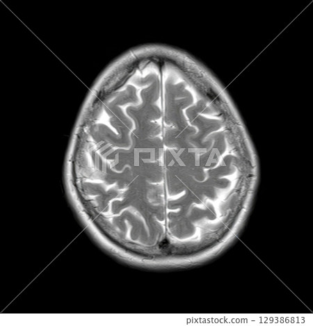 Axial T2-weighted MRI of a 44-year-old patient showing normal brain structures. No visible abnormalities. High signal in CSF and clear cortical sulci 129386813