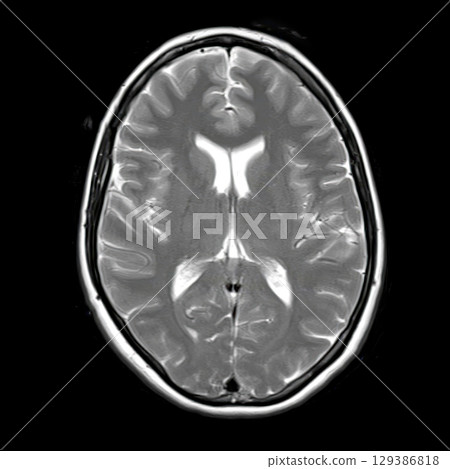 Axial T2-weighted brain MRI of a 40-year-old showing normal anatomy of lateral ventricles, thalamus, and basal ganglia without visible pathology. Axial T2-weighted brain MRI of a 40-year-old showing normal anatomy of lateral ventricles, thalamus, and basal ganglia without visible pathology. 129386818