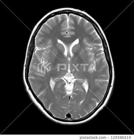 Axial T2-weighted brain MRI of a 40-year-old showing normal anatomy of lateral ventricles, thalamus, and basal ganglia without visible pathology. Axial T2-weighted brain MRI of a 40-year-old showing normal anatomy of lateral ventricles, thalamus, and basal ganglia without visible pathology. 129386819