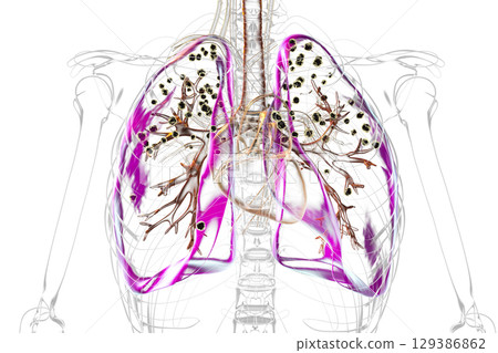 Lungs affected by silicosis, illustration Lungs affected by silicosis, illustration 129386862