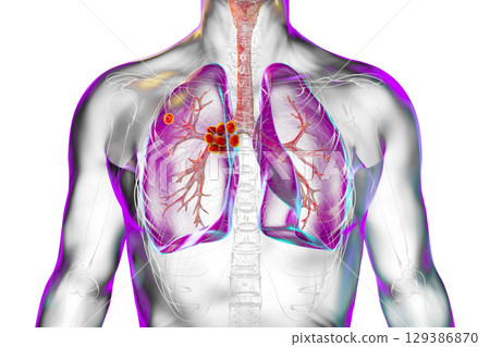 Primary lung tuberculosis, illustration Primary lung tuberculosis, illustration 129386870