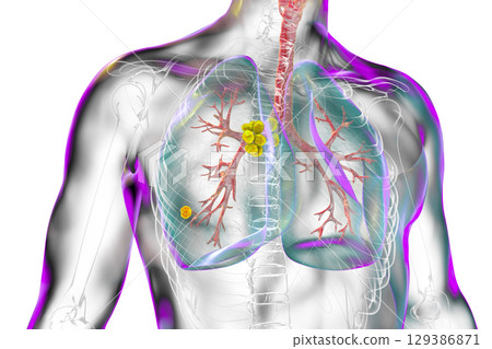 Primary lung tuberculosis, illustration Primary lung tuberculosis, illustration 129386871