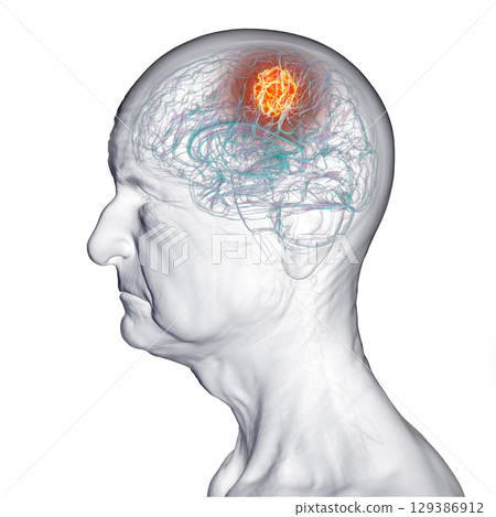Brain tumor, 3D illustration Brain tumor, 3D illustration 129386912