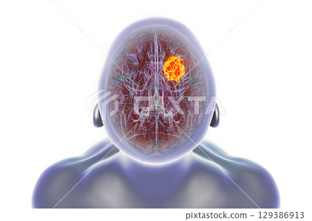 Brain tumor, 3D illustration Brain tumor, 3D illustration 129386913