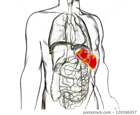 Splenomegaly, 3D illustration 129386957