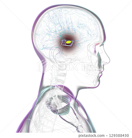 Human brain with degenerated substantia nigra in Parkinson's disease, 3D illustration. 129388430