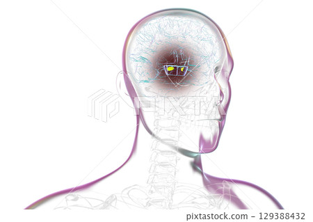 Human brain with degenerated substantia nigra in Parkinson's disease, 3D illustration. 129388432