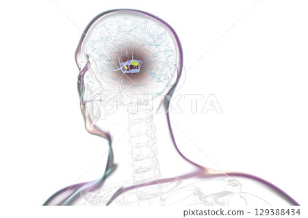 Human brain with degenerated substantia nigra in Parkinson's disease, 3D illustration. 129388434