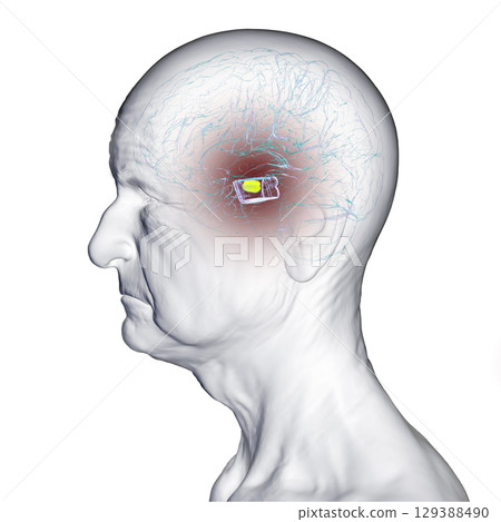 Human brain with degenerated substantia nigra in Parkinson's disease, 3D illustration Human brain with degenerated substantia nigra in Parkinson's disease, 3D illustration 129388490