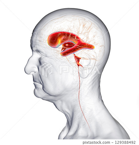 Normal pressure hydrocephalus, 3D illustration Normal pressure hydrocephalus, 3D illustration 129388492