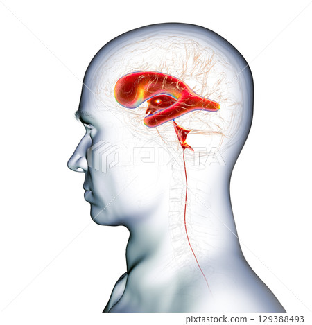 Normal pressure hydrocephalus, 3D illustration Normal pressure hydrocephalus, 3D illustration 129388493