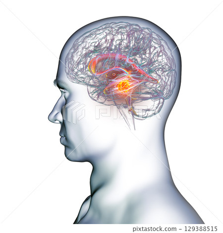 A brain tumor causing hydrocephalus, 3D illustration A brain tumor causing hydrocephalus, 3D illustration 129388515