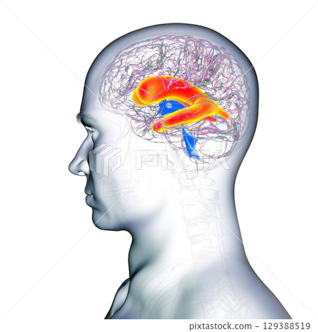 Enlarged lateral ventricles of the brain, 3D illustration 129388519