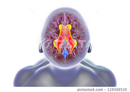 Enlarged lateral ventricles of the brain, 3D illustration 129388520