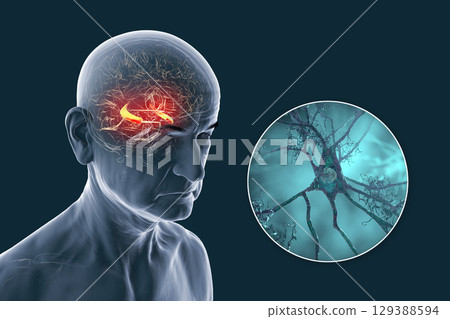 Alzheimer's disease, 3D illustration 129388594