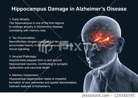 Alzheimer's disease, 3D illustration 129388595