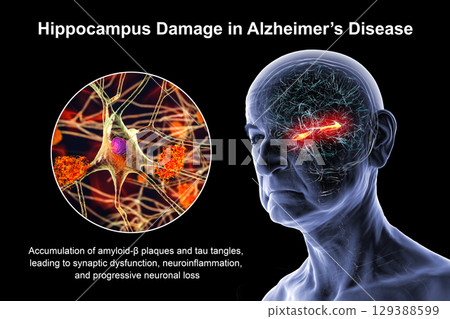 Alzheimer's disease, 3D illustration 129388599