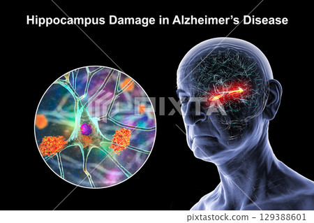 Alzheimer's disease, 3D illustration Alzheimer's disease, 3D illustration 129388601