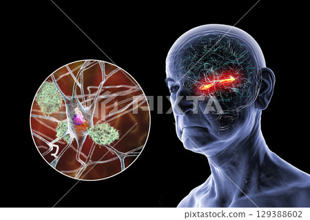 Alzheimer's disease, 3D illustration Alzheimer's disease, 3D illustration 129388602