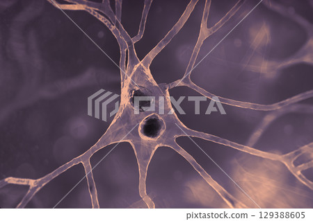 Lewy body dementia, 3D illustration Lewy body dementia, 3D illustration 129388605
