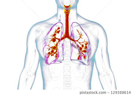 Lungs affected by cystic fibrosis, illustration Lungs affected by cystic fibrosis, illustration 129388614