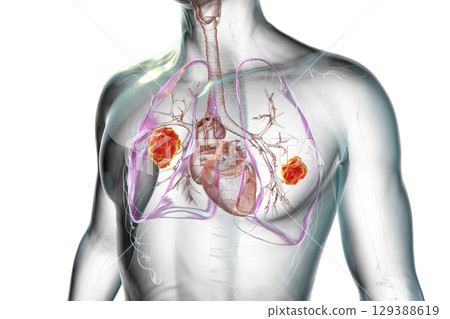 Lung mucormycosis, illustration 129388619