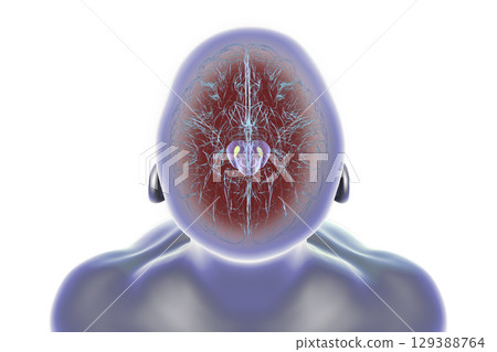 Human brain with degenerated substantia nigra in Parkinson's disease, 3D illustration. 129388764