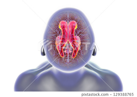 Normal pressure hydrocephalus, 3D illustration 129388765