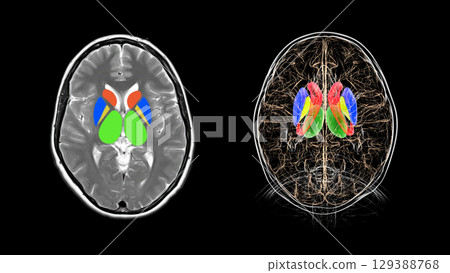 Human brain with caudate nucleus (red), thalamus (green), putamen (blue), and globus pallidus (yellow) highlighted, showing key basal ganglia and relay centers, 3D illustration and MRI scan Human brain with caudate nucleus (red), thalamus (green), putamen (blue), and globus pallidus (yellow) highlighted, showing key basal ganglia and relay centers, 3D illustration and MRI scan 129388768