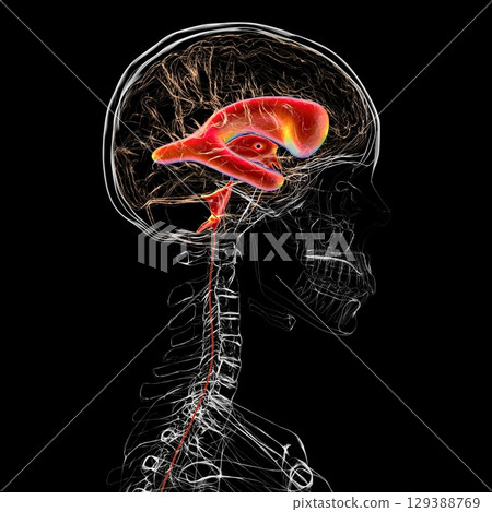 Normal pressure hydrocephalus, 3D illustration Normal pressure hydrocephalus, 3D illustration 129388769