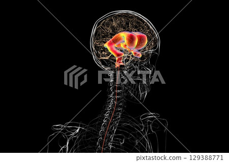 Normal pressure hydrocephalus, 3D illustration Normal pressure hydrocephalus, 3D illustration 129388771