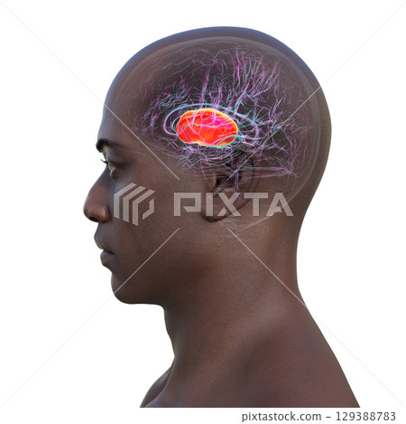 Internal capsule, 3D illustration. Highlighted in red within the human brain. Internal capsule, 3D illustration. Highlighted in red within the human brain. 129388783