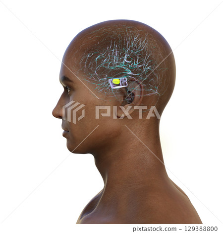 Human brain with degenerated substantia nigra in Parkinson's disease, 3D illustration. Human brain with degenerated substantia nigra in Parkinson's disease, 3D illustration. 129388800