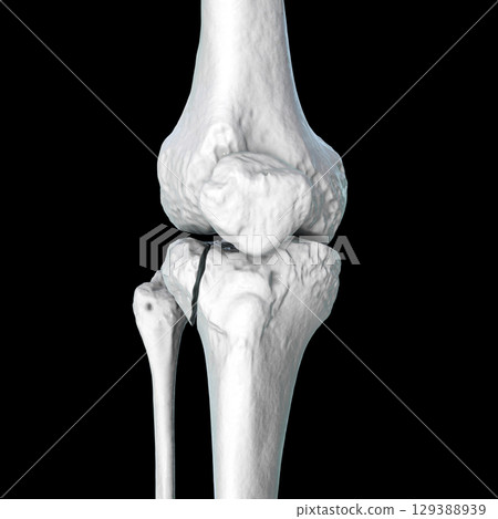 Tibia fracture Schatzker type I, 3D illustration 129388939