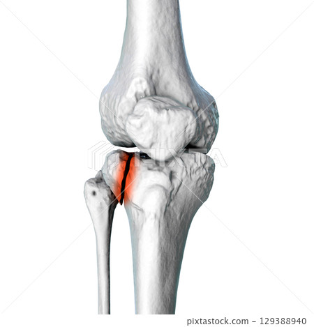 Tibia fracture Schatzker type I, 3D illustration Tibia fracture Schatzker type I, 3D illustration 129388940