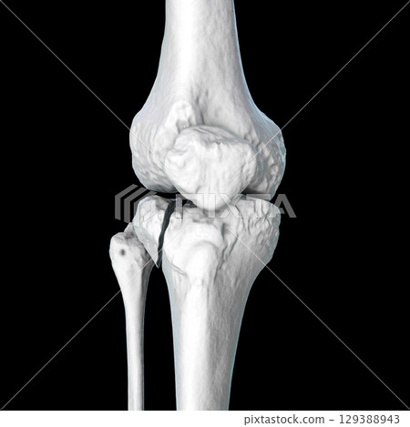 Tibia fracture Schatzker type II, 3D illustration Tibia fracture Schatzker type II, 3D illustration 129388943