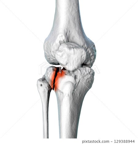 Tibia fracture Schatzker type II, 3D illustration Tibia fracture Schatzker type II, 3D illustration 129388944