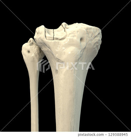 Tibia fracture Schatzker type III, 3D illustration Tibia fracture Schatzker type III, 3D illustration 129388945