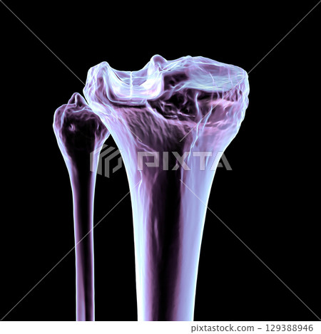Tibia fracture Schatzker type III, 3D illustration Tibia fracture Schatzker type III, 3D illustration 129388946