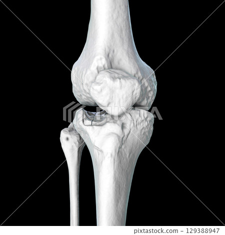 Tibia fracture Schatzker type III, 3D illustration Tibia fracture Schatzker type III, 3D illustration 129388947