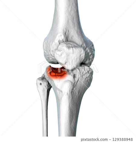 Tibia fracture Schatzker type III, 3D illustration 129388948
