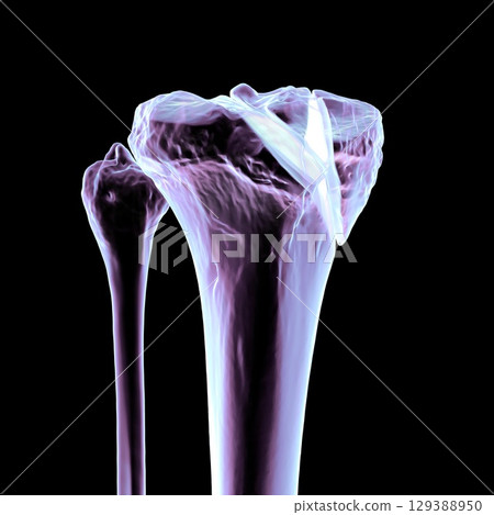 Tibia fracture Schatzker type IV, 3D illustration Tibia fracture Schatzker type IV, 3D illustration 129388950